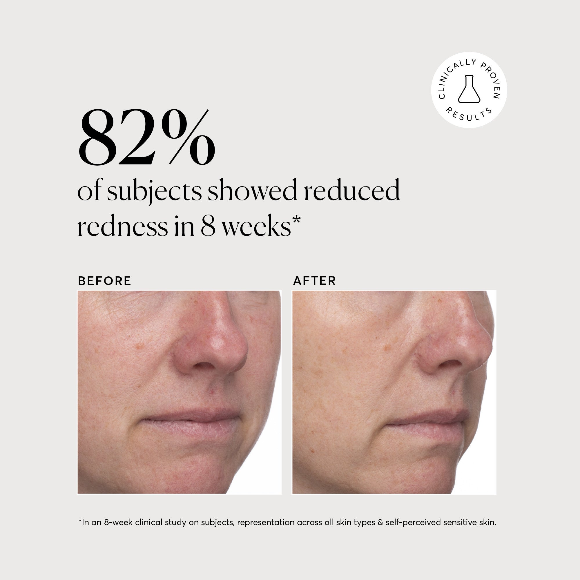 Azelaic Topical Acid 10%